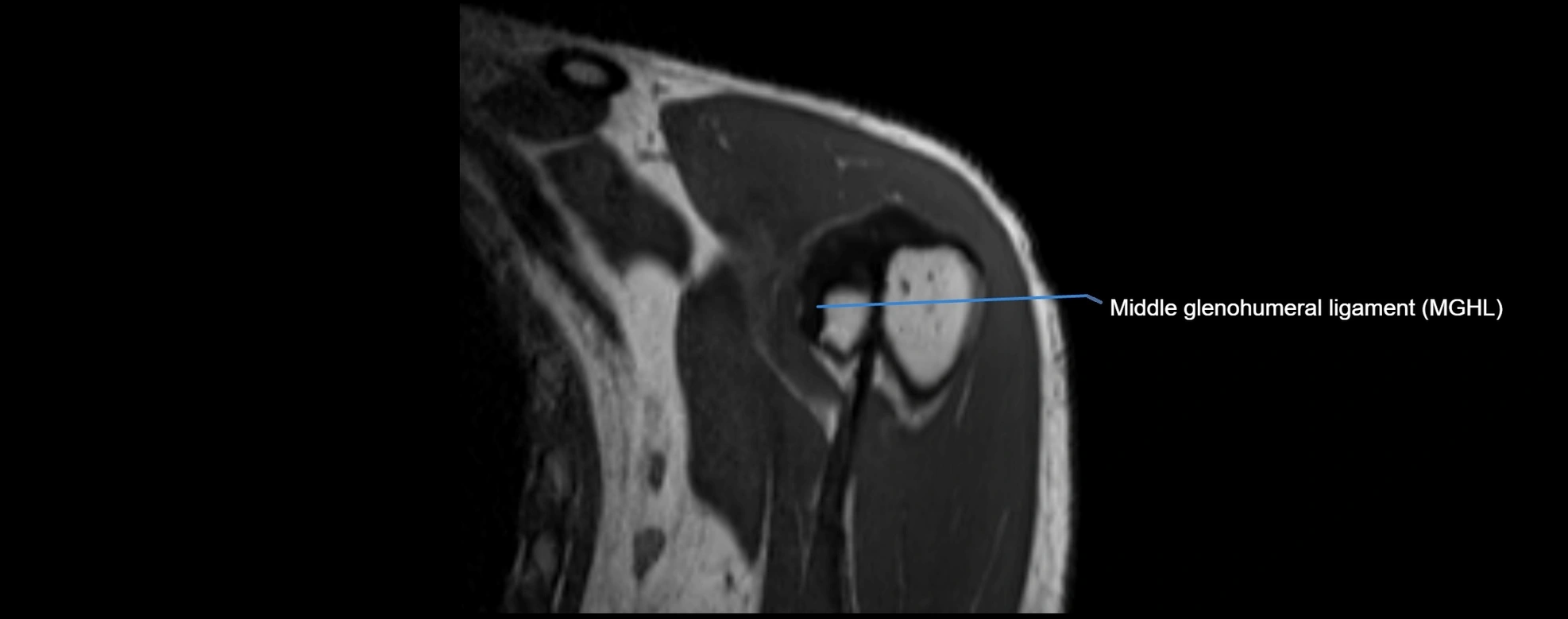 shoulder ligments coronal  cross sectional anatomy 3T MRI AI enhanced radiology image -img-00001-00006.webp